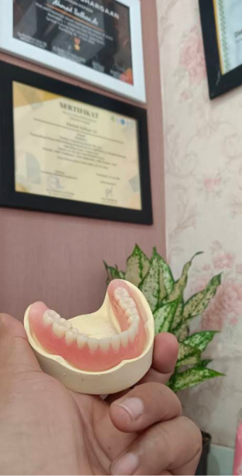 Hasil kerja JOE DENTAL — gigi palsu lepasan buatan tukang gigi Bandung (foto 10)